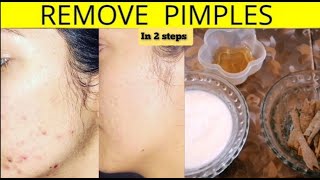 2 Simple Steps To Remove Pimples  How To Get A Rid Of Pimples [upl. by Drue]