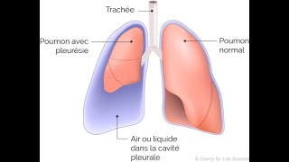 ECN 🤩 épanchement pleural  pleurésie à liquide clair  🤩 excellente explication [upl. by Aisorbma]