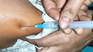 Arms im injection pushIntramuscular Ketorolac 30mg injection video24 Ep97 by LaFiN injection push [upl. by Suzi]