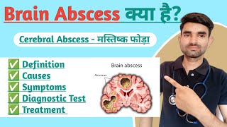 Brain Abscess Lecture in Hindi  Causes Symptoms And Treatment of Brain Abscess [upl. by Airotkciv289]