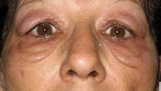 Instructional Video  Biochemic Cell Salt Facial Diagnosis  Vid 4 [upl. by Terryn]