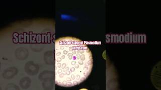 Schizont stage of Plasmodium falciparum  Malarial Parasitology [upl. by Pomfrey]