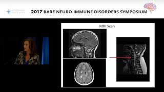 What are rare neuroimmune disorders [upl. by Vitkun]