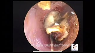 Cholesteatoma of the external auditory canal at different stages 11 minutes [upl. by Ligetti]