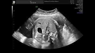 Fetal Breathing Respiratory movements Biophysical profile [upl. by Liatrice]