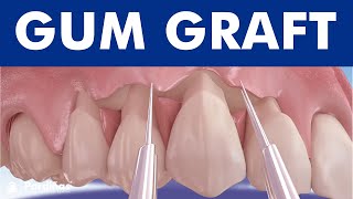 Gum graft  Coronally advanced flap  Receding gums treatment © [upl. by Roda]