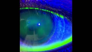 Conjunctive Staining After Scleral Lens Removal [upl. by Ellertnom]