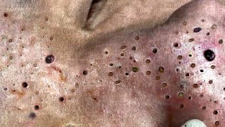 Big Cystic Acne Blackheads Extraction Blackheads amp Milia Whiteheads Removal Pimple Popping  5396 [upl. by Elinore468]