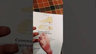 Plantar fasciitis in hindi  cure and treatment and exercises india [upl. by Marella]