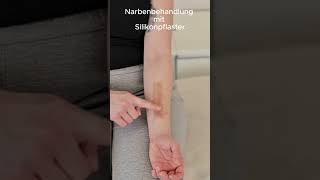 Narbenbehandlung mit Silikonpflaster [upl. by Linad]