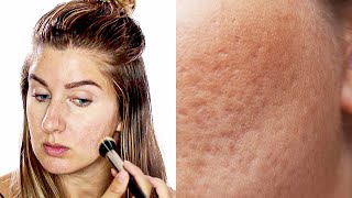 Dos And Donts To Applying Makeup On Pitted Acne Scars  Icepick Scars Boxcar scars [upl. by Sukramed]