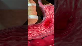 Formation of an Ulcer in the Stomach [upl. by Neddra]