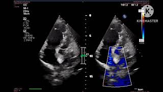 Sinus Venosus ASD of SVC type [upl. by Barta]