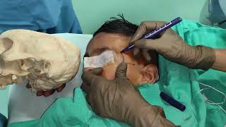 Suprazygomatic approach maxillary nerve block Our take [upl. by Llezom]