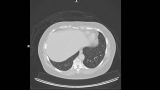 How CT scans work Houndsfield units [upl. by Eednas743]