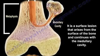 Osteochondroma  solitary and multiple  Everything You Need To Know  Dr Nabil Ebraheim [upl. by Nauqal]