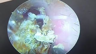 Processing fungal thick dry patches on the eardrum earwax Cleaning earwaxremoval doctoranh [upl. by Netty]