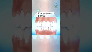 Clareamento dental 💎 [upl. by Norvall758]