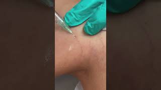 Sclerotherapy for Spider Veins [upl. by Nivrae]