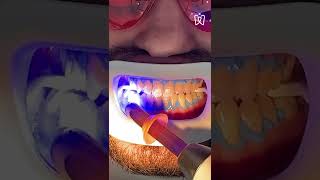 Teeth whitening process [upl. by Sashenka]