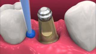 Smyl Manatee  Dental Implant Procedure [upl. by Gratianna]