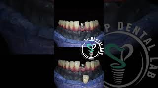 Screw retained Tianium Bridge [upl. by Nymsaj]