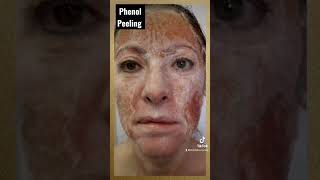 Phenol Peeling is powerful but no one is talking about it PhenolPeeling SkinLightening AntiAging [upl. by Srini]