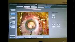 CALLISTO Eye system  Chirurgie de la cataracte Dr Coullet Montpellier [upl. by Boiney]