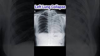 Left Lung Collapse [upl. by Anecuza]