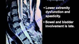 Cervical Spine Myelopathy  Everything You Need To Know  Dr Nabil Ebraheim [upl. by Auhsuoj833]