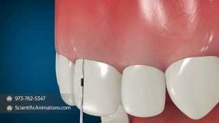 Esthetical Crown Lengthening Animation  Dental Animation [upl. by Anisor]