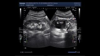 Ultrasound Video showing renal Angiomyolipoma with stones at PUJ [upl. by Nerraj]