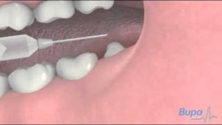 How a wisdom tooth is removed [upl. by Geehan]