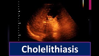 Cholelithiasis  Thickened sludge within the Gall Bladder lumen  Enlarge prostate [upl. by Ofori558]