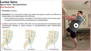 Stork Standing Test for Spondylolisthesis  Rationale amp Interpretation [upl. by Mcgurn]