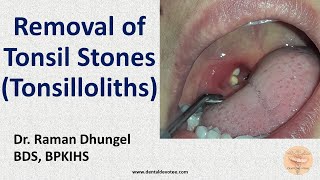 Tonsil Stone Removal  Tonsillolith removal by Dr Raman Dhungel [upl. by Sanalda]