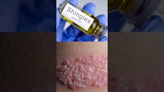 How Chicken Pox Leads to Shingles Herpes Zoster chickenpox shingles vaccine shorts DMC [upl. by Baiel]