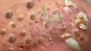 Loan Nguyen Acne Treatment 1772h [upl. by Cutlerr]