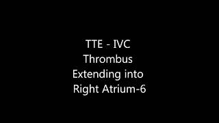 IVC Thrombus Extending into Right Atrium  Transthoracic Echocardiogram TTE [upl. by Nada]