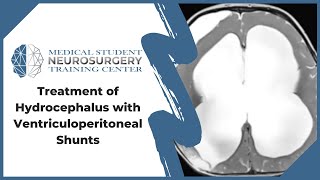 Treatment of Hydrocephalus with Ventriculoperitoneal Shunts [upl. by Booker469]