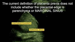 MARGINAL SINUS OF PLACENTA ABRUPTIO PLACENTA HEMORRHAGE PLACENTA PREVIA A2Z OF ULTRASOUND [upl. by Charpentier]