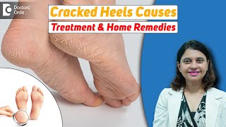 10 Home Remedies for CRACKED HEELS  Magical Cracked Heel RemediesDr Amee Daxini  Doctors Circle [upl. by Post21]