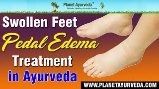 Swollen Feet  Pedal Edema Treatment in Ayurveda [upl. by Itirahc]