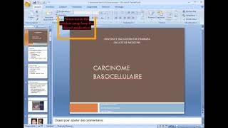 carcinome basocellulaire [upl. by Tahmosh]