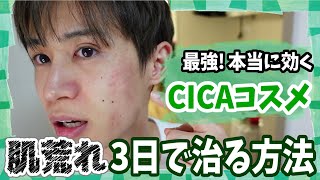 【肌荒れ 3日で治す】最強 本当に効くおすすめCICAコスメはコレだぁ [upl. by Ahsahtan]