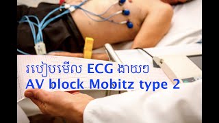 68 EKG Mobitz type 2  ករណិសិក្សារ​ ECG លើអ្នកជំងឺមាន AV block type 2 [upl. by Sherourd]