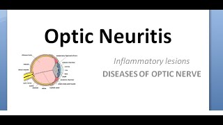 Ophthalmology Optic neuritis Papillitis NeuroRetinitis RetroBulbar phosphenes uhthoff pulfrich [upl. by Atteyek775]