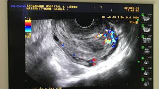 Pelvic congestion syndrome with RPOC USG Ultrasound [upl. by Akenna]