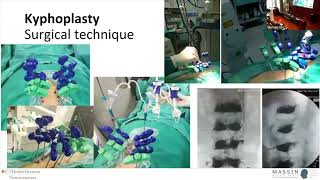 Vertebroplasty or Kyphoplasty  MASSIN Congress Day 2  Session 6 Talk 3 [upl. by Hester762]