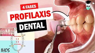 PROFILAXIS DENTAL 4 fases ¿Cómo llenar el Indice IHOS [upl. by Tab]